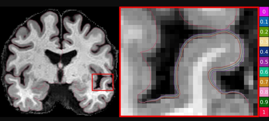 Australian researchers use machine learning (AI) to advance Alzheimer’s research